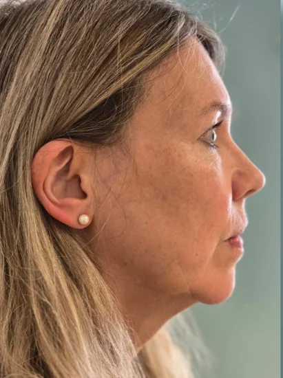 Kundin (56) vor dem Training mit der FACE-Methode®, Profilansicht